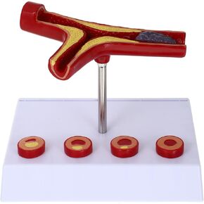 Baluue Human Atherosclerosis Cardiovascular Medical Model: Blood Vessel Anatomical Model Medical Teaching Supplies for School Students