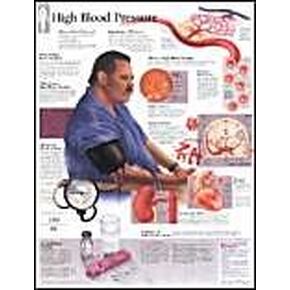 High Blood Pressure chart: Laminated Wall Chart
