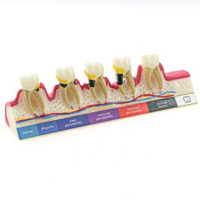 Dental Periodontal Disease Teeth Model Doctor-Patient and Oral Care Education Model