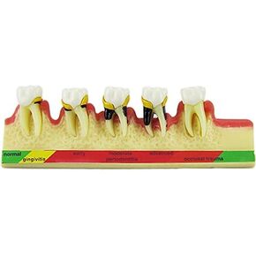 Dental Periodontal Disease assort Tooth Teeth Typodont Study Teaching Model NEW