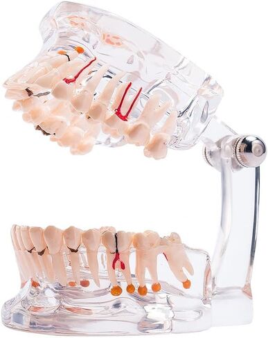 Transparent Dental Implant Disease Teeth Model, Standard Pathology Teaching Model (Pathology) in Saudi Arabia