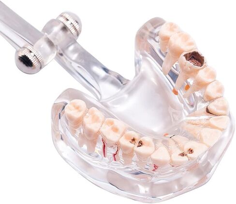 Transparent Dental Implant Disease Teeth Model, Standard Pathology Teaching Model (Pathology) in Saudi Arabia