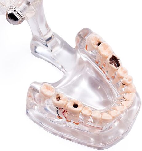 Transparent Dental Implant Disease Teeth Model, Standard Pathology Teaching Model (Pathology) in Saudi Arabia