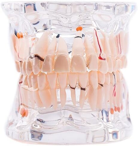 Transparent Dental Implant Disease Teeth Model, Standard Pathology Teaching Model (Pathology) in Saudi Arabia