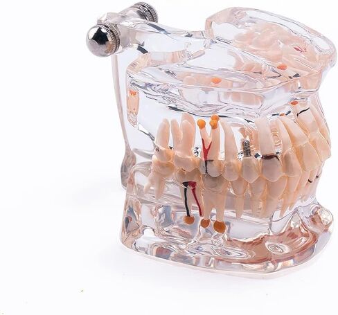 Transparent Dental Implant Disease Teeth Model, Standard Pathology Teaching Model (Pathology) in Saudi Arabia
