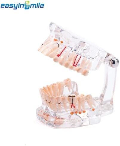 Transparent Dental Implant Disease Teeth Model, Standard Pathology Teaching Model (Pathology) in Saudi Arabia