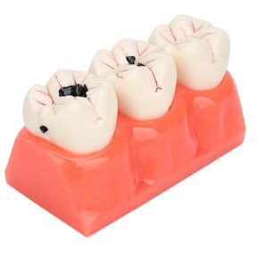 4 Times Caries Evolution Model Detachable Teeth Disease Teach Anatomy Model for Dentist Teaching Learning