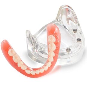 Dental Overdenture Inferior Model - Dental Implants Demo Model 4 Nail Dental Implant Model for Education and Communication