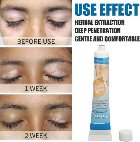 Vitiligo Cream Safe herbal extract Ointment for of vitiligo Natural professional skin pigmentation for individual care in Saudi Arabia
