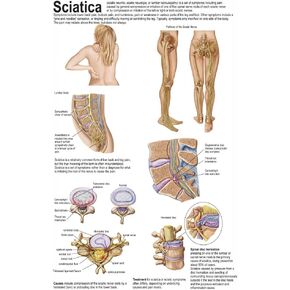 Posterazzi Medical chart showing the signs and symptoms of sciatica Poster Print, (11 x 17)