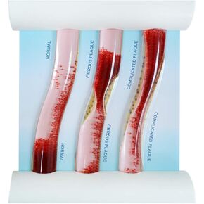 Medarchitect Low-Density Lipoprotein LDL Blood Vessel Model for Medical Patient Doctor Teaching