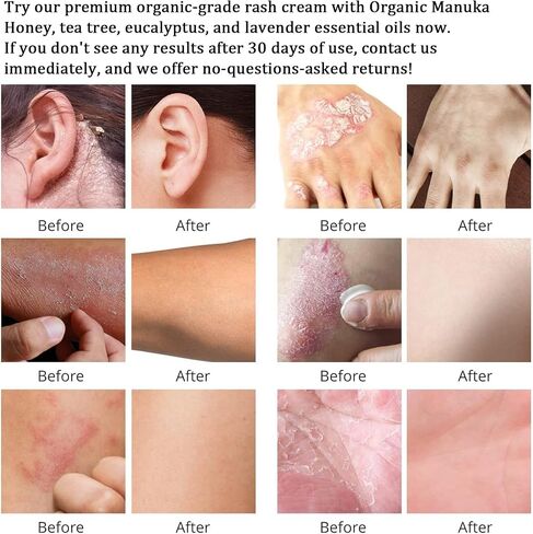 Max Strength Treat Natural Organic Manuka Cream Ointment, Soothing Relief Dry, Heat Rash, Tinea Versicolor, Hidradenitis, Itchy, Psoriasis, Leg, Belly, Armpit, Foot, Hand, Irritable Skin For All Ages in Saudi Arabia