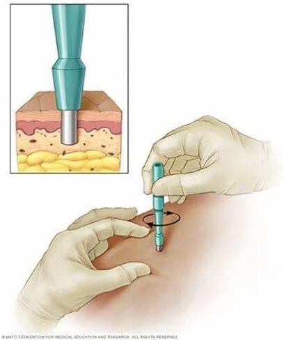 Disposable Skin Biopsy Punch Stainless Steel Sample Pack (Pack of 17) (5 mm) in Saudi Arabia