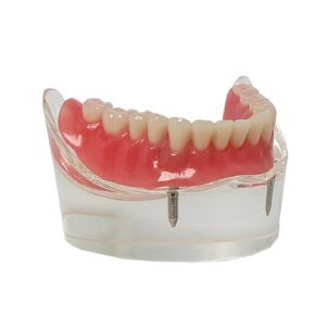 Dental Typodont Implant Transparent Model, Lower Jaw Type, Removable All-on-4 Restoration Overdenture, with 4 Implants (Lower Jaw -M6027)