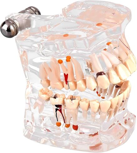 Teeth Model Dental Model Mouth Model Transparent Gingival Tooth Education Model Disease with Nerve for Dental Teaching Study in Saudi Arabia