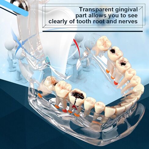 Teeth Model Dental Model Mouth Model Transparent Gingival Tooth Education Model Disease with Nerve for Dental Teaching Study in Saudi Arabia