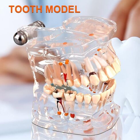 Teeth Model Dental Model Mouth Model Transparent Gingival Tooth Education Model Disease with Nerve for Dental Teaching Study in Saudi Arabia