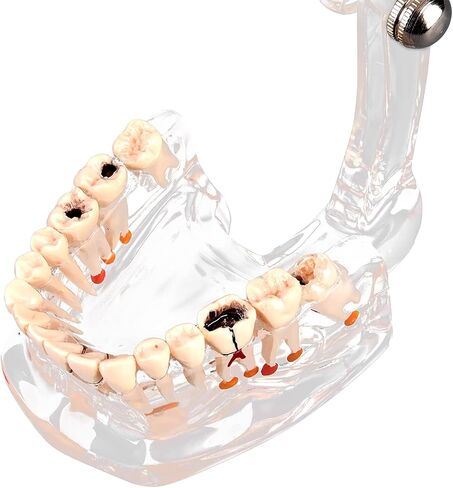 Teeth Model Dental Model Mouth Model Transparent Gingival Tooth Education Model Disease with Nerve for Dental Teaching Study in Saudi Arabia