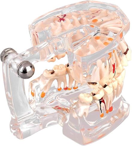 Teeth Model Dental Model Mouth Model Transparent Gingival Tooth Education Model Disease with Nerve for Dental Teaching Study in Saudi Arabia