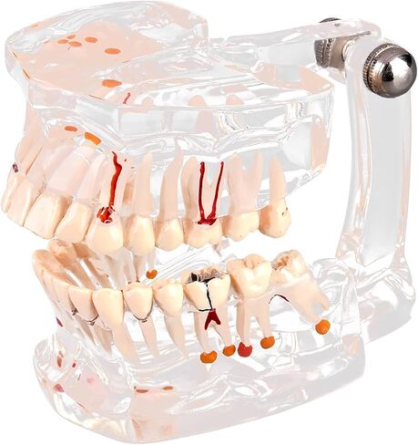 Teeth Model Dental Model Mouth Model Transparent Gingival Tooth Education Model Disease with Nerve for Dental Teaching Study in Saudi Arabia