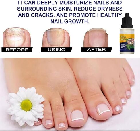 Plant Drops,Oregano Tea Tree Drops,Tea Tree and Oregano Oil for Nails Care,Plant Drops - Plant Drops for Nails Care,10 Ml/0.34 Fl.oz (2pcs) in Saudi Arabia