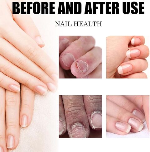 Plant Drops,Oregano Tea Tree Drops,Tea Tree and Oregano Oil for Nails Care,Plant Drops - Plant Drops for Nails Care,10 Ml/0.34 Fl.oz (2pcs) in Saudi Arabia
