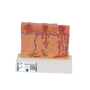 3B Scientific J15 Skin Cancer Model - 3B Smart Anatomy