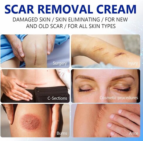 Scar Removal Cream, Scar Repair Cream for Acne Scars, Stretch Marks, Surgical Scars, Burns, Old and New Scars, Natural Formula Scar Cream for Face and Body, Suitable for Most Skin Types in Saudi Arabia