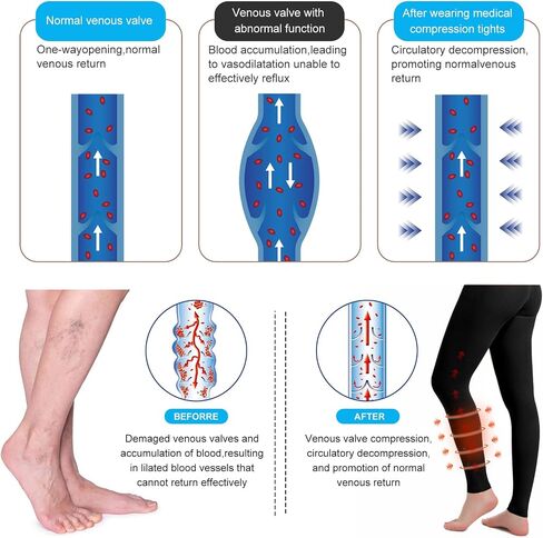 2 Pairs Medical Compression Pantyhose for Men & Women, 20-30mmhg Gradient Support Tights pants, Open Toe High Waist Tights, Graduated Tights for Varicose Veins, Edema, Deep, Vein, Thrombosis , During, Flight in Saudi Arabia