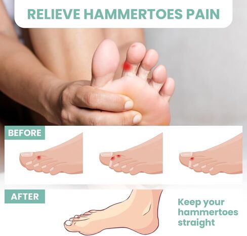 Welnove Hammertoe Corrector Gel Toe Straighteners - 8 Pcs Toe Support Pads Cushion - Realign Bent, Crooked, Curled, Claw, Hammer Toes - Firm Support in Saudi Arabia