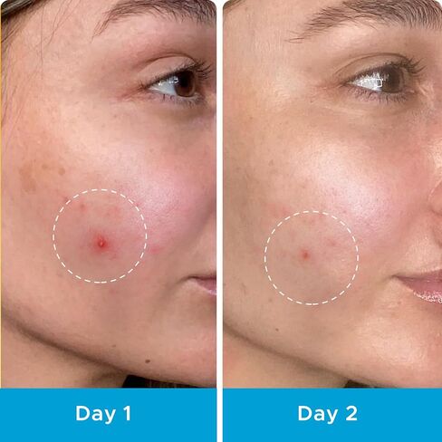 رقع البثور من ليتبير، غطاء بقعة غير مرئي، رقع حب الشباب الغروانية المائية للوجه مع حافة خارجية أرق، رقعة ماصة لحب الشباب بحمض الساليسيليك للرؤوس البيضاء وحب الشباب الكيسي، 3 أحجام 66 قطعة in Kuwait