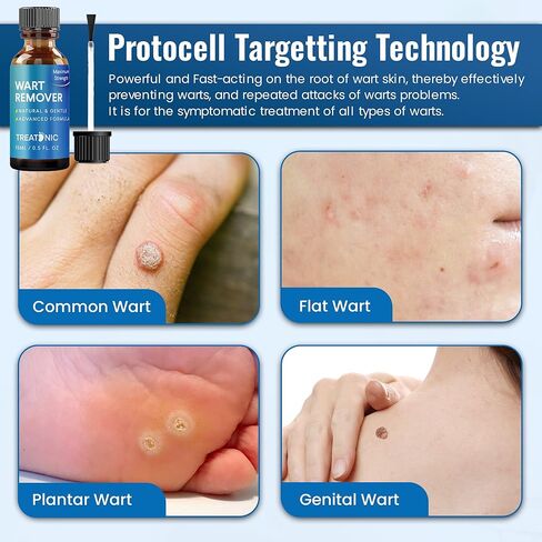 مزيل الثآليل ذو القوة القصوى: إزالة الثآليل سريعة المفعول، مزيلات الثآليل الأخمصية بدون ألم، شائعة، علاج الثآليل المسطحة بالتجميد in Kuwait