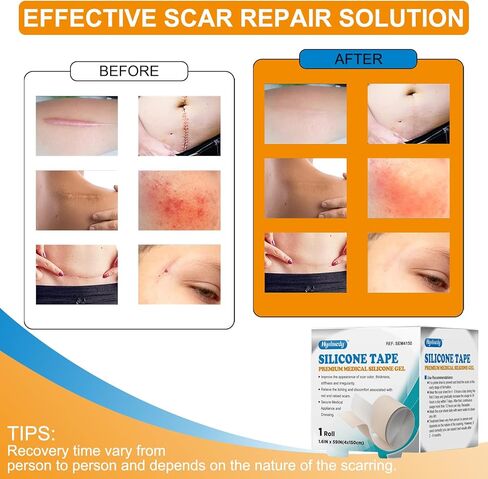 صفائح الندبات المصنوعة من السيليكون، بكرة شريط الندبات من جل السيليكون (1.6 بوصة × 59 بوصة - 1.5 متر) - شرائط إزالة الندبات المصنوعة من السيليكون المقاومة للماء وقابلة لإعادة الاستخدام للقسم القيصري والجُدرَة وعلامات التمدد وشفاء الندبات in Kuwait