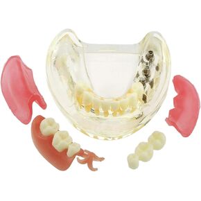Dental Typodont Implant Teeth Model Overdenture 3 Implants Bridge Inferior Lower Restoration Treatment Demo M6006 for Studying Teaching