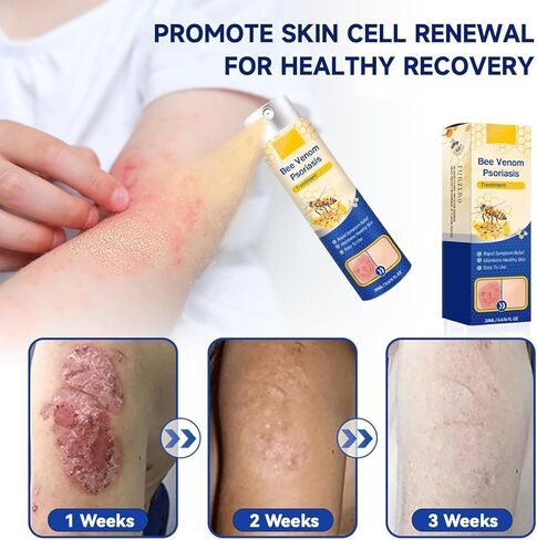 علاج الصدفية بسم النحل من بيسورياهيل، تخفيف الصدفية، صدفية سم النحل، سم النحل للنساء والرجال لجميع أنواع البشرة (قطعتان) in Kuwait