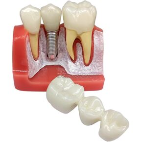 Dental Typodont Implant Model 4 Times Teeth Model Removable Analysis Crown Bridge Demo Teeth Model for Class Education and Studying M2017