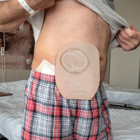 100 Pcs Replacement Crescents Elastic Ostomy Barrier Strips Ostomy Supplies Adhesive Backing Ostomy Pouch for Colostomy Stoma Bags in Saudi Arabia