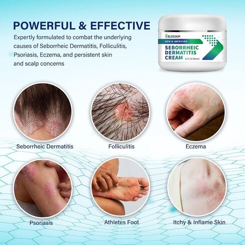 Seborrheic Dermatitis Cream, Folliculitis Treatment, Psoriasis Cream, Anti-Itch Cream, Scalp Treatment for Psoriasis, Dry Scalp, Dandruff, Seborrheic Dermatitis Treatment, Soothing Relief in Saudi Arabia