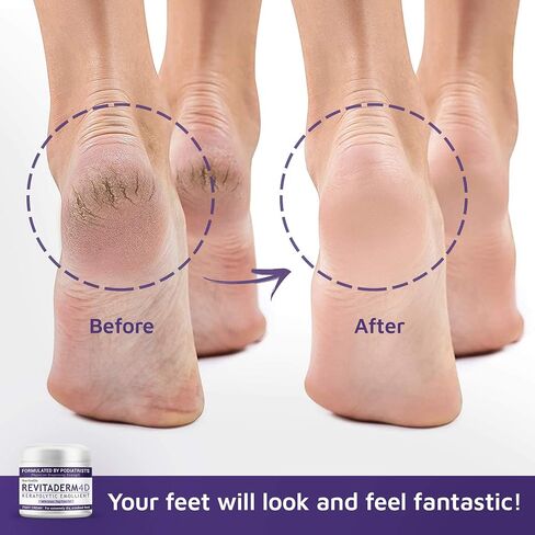 Revitaderm 4D Urea Cream, Deeply Moisturizes for Dry, Cracked Feet, Hands, Elbows and Knees, Ultra Repair Cream and Callus Remover For Feet, Free Pumice Stone Included, 4oz, 1 Pack in Saudi Arabia