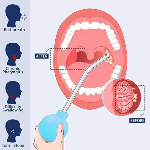 Tonsil Stone Remover Vacuum Tonsil Stone Removal Kit with Light Easy to Use Fight Bad Breath-Azure in Saudi Arabia