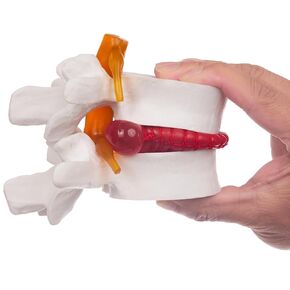 Human Anatomical Lumbar Disc Herniation Model, 1.5 Times Life Size Lumbar Vertebrae Disc Herniation Model, Portable Lumbar Spine Model for Medical, Teaching and Demonstrating