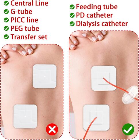 15 قطعة من ضمادات أنبوب التغذية اللاصقة المقسمة، Peg G J Supra-Pubic شق يحدها وسادة شاش، رقعة تصريف معقمة لوازم تضميد الجزيرة، حامل جهاز تثبيت القسطرة للعناية التمريضية in Kuwait