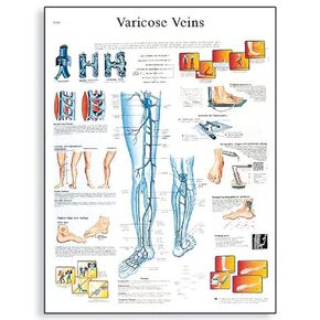 3B Scientific VR1367L Glossy Laminated Paper Varicose Veins Anatomical Chart, Poster Size 20" Width x 26" Height