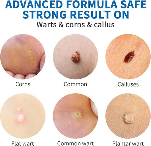 مزيل ثآليل هينجولوس بالتجميد، مزيل ثآليل أخمصي سريع المفعول للأقدام، مزيل ثآليل الساليسيليك للرجال والنساء، مزيلات الذرة لأصابع القدم- NDC Codo(s): 84010-036-01 in Kuwait