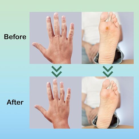 Fast Acting Liquid Wart Remover, Plantar Wart Remover, Corn Removers for Feet, Salicylic Acid Wart Removal, Corn Removers for Feet Extra Strength in Saudi Arabia