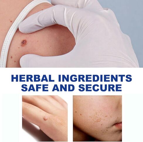 سائل مزيل الثآليل - قناع جل ذو قوة قصوى مع تركيبة حصرية لإزالة الثآليل الأخمصية والثآليل الشائعة بسرعة. آمنة وطبيعية وقوية in Kuwait