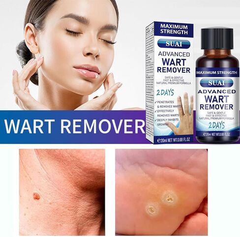 سائل مزيل الثآليل - قناع جل ذو قوة قصوى مع تركيبة حصرية لإزالة الثآليل الأخمصية والثآليل الشائعة بسرعة. آمنة وطبيعية وقوية in Kuwait