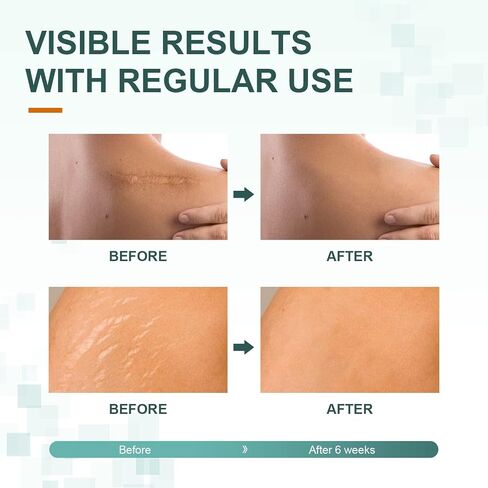 Silicone Scar Sheets, Tape, Strips 120" x 1.5" Roll-Heal Keloid, C-Section and Tummy Tuck - As Surgical Cream, Gel, Patch, Bandage in Saudi Arabia