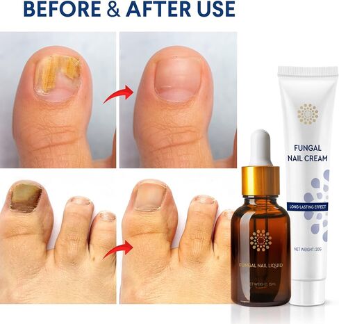 Toenail Fungus Treatment for Toenail and Fingernails: Fungus Nail Treatment Liquid 15ML and Antifungal Nail Repair Cream 20G - Nail Fungus Treatment Extra Strength - Plant Extract Ingredients in Saudi Arabia