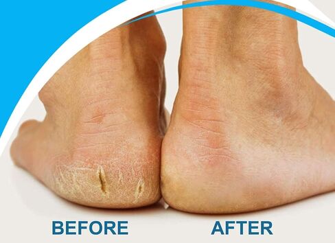 Pedi Electronic Pedicure Foot File - Callus Remover and Shaver for Dry Feet & Cracked Heels ✮ 1 Extra Mineral Pumice Stone Roller Head ✮ Show Immediate Results ✮ for Men & Woman (Aqua) in Saudi Arabia
